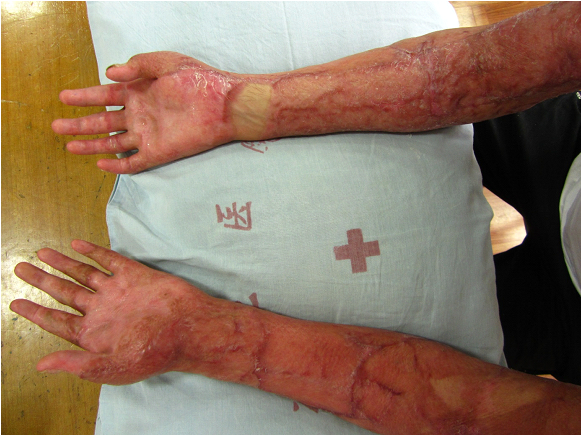 Burn wounds Burn wounds